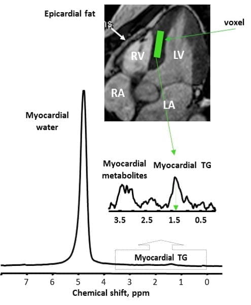 Myocardial Metabolism
